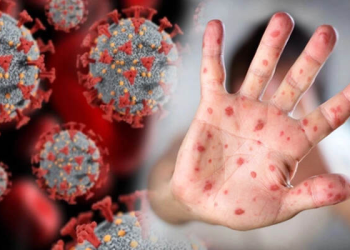 DSÖ’den kritik açıklama: Maymun çiçeği ve Kovid-19 bulaşma farkı…